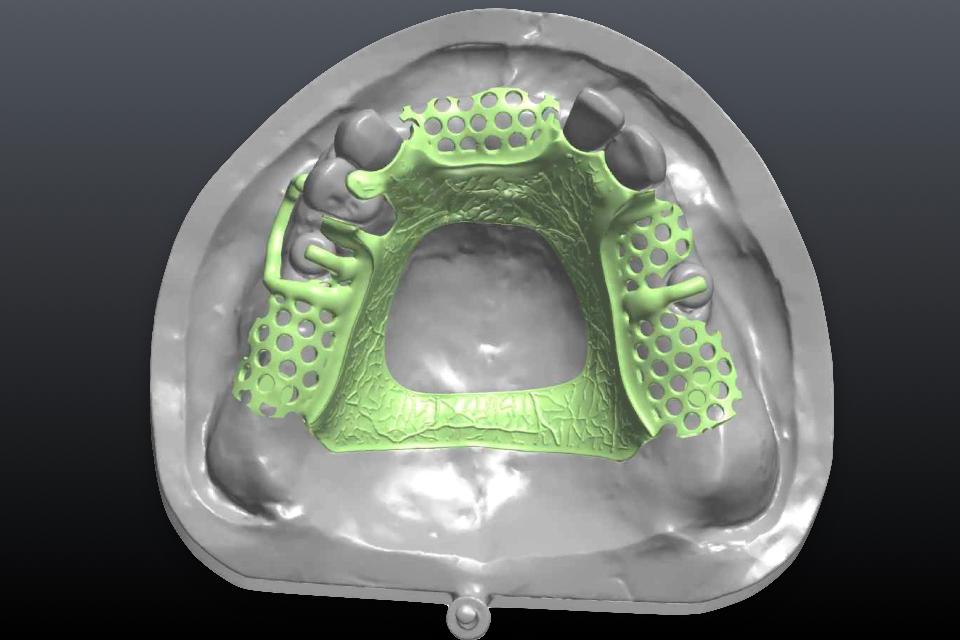 Fig. 46: Continuation of digital prosthesis design after analog cast digitalization