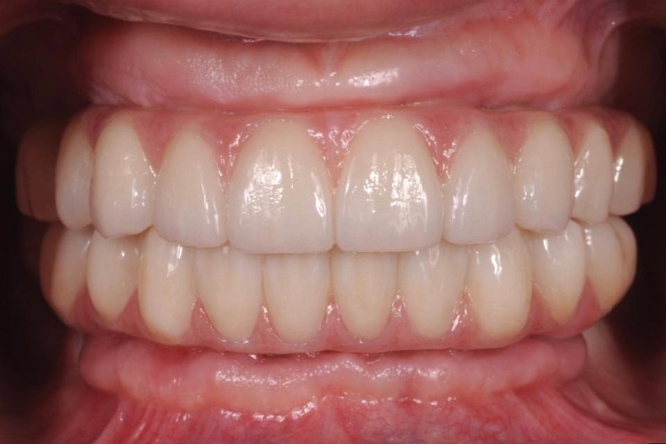 Fig. 33: Intraoral view of seated milled maxillary and mandibular definitive zirconia prostheses