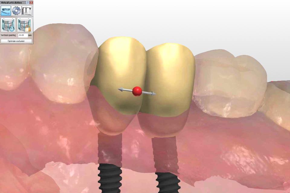 Fig. 43: Virtual design of CAD/CAM monolithic zirconia implant crowns