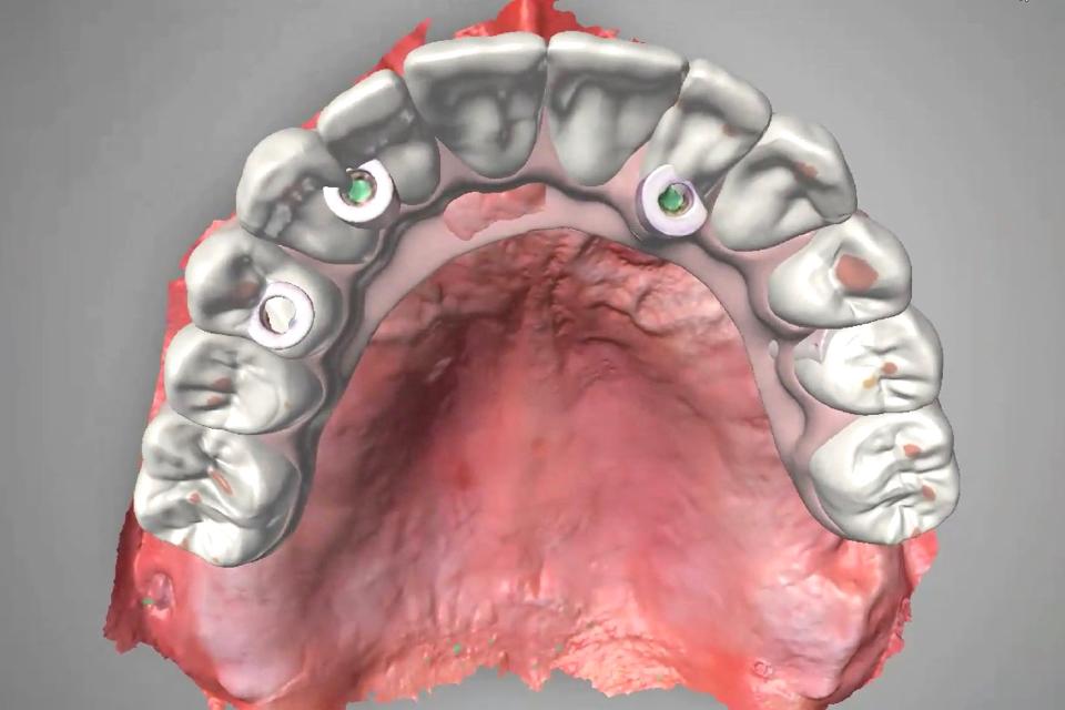 Fig. 8: Occlusal view of CAD/CAM interim PMMA hybrid prosthesis