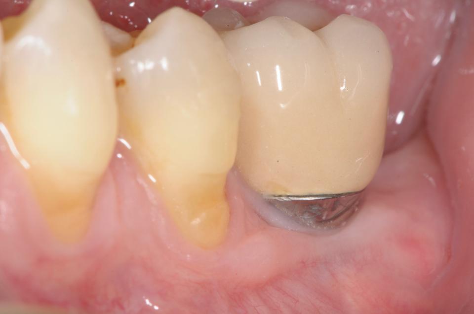 Fig. 4k: Buccal view at the 10-year follow-up, demonstrating the stability of the soft tissue margin