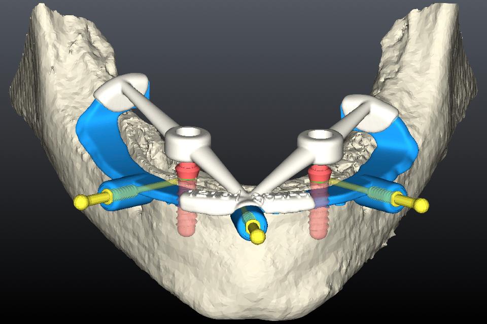 Fig. 39: Design of CAD/CAM bone reduction and surgical template for s-CAIS