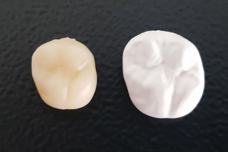 Fig. 5: Volume discrepancy between the enlarged “white stage” and the same crown after sintering