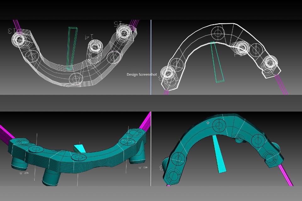 Fig. 13: Computer validation of the design of CAD/CAM bar