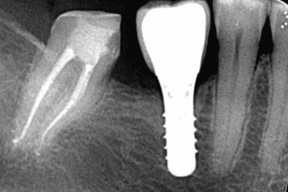 Fig. 3h: Radiographic image, taken at the 3-year follow-up, showing ideal interproximal bone levels