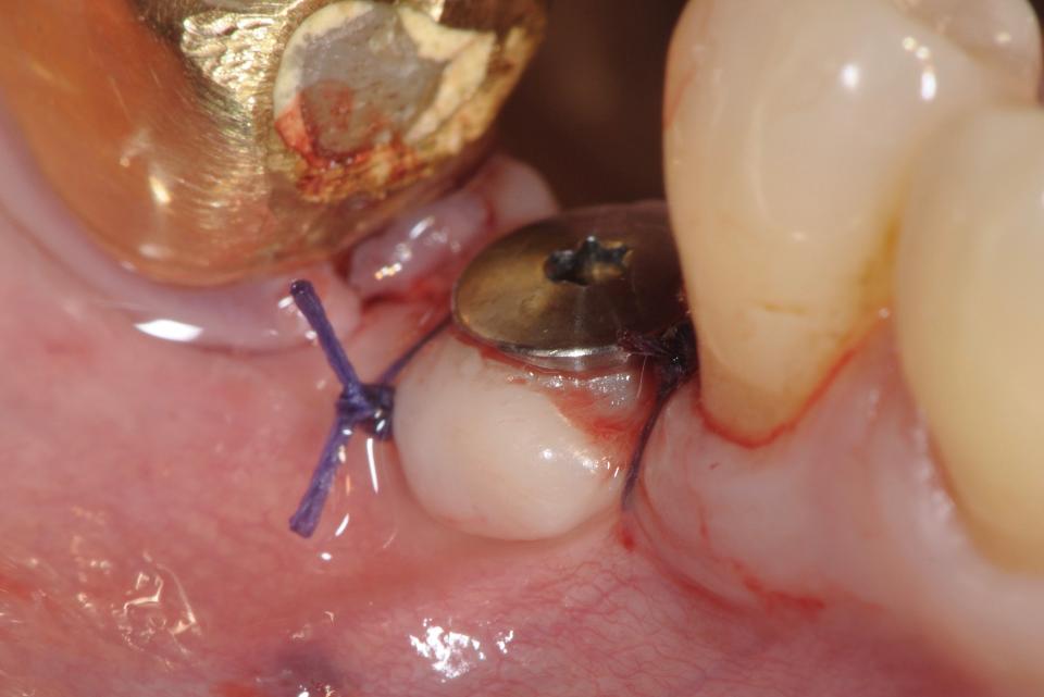 Fig. 3f: Non-submerged healing of the FGG sutured with 4-0 Vicryl™