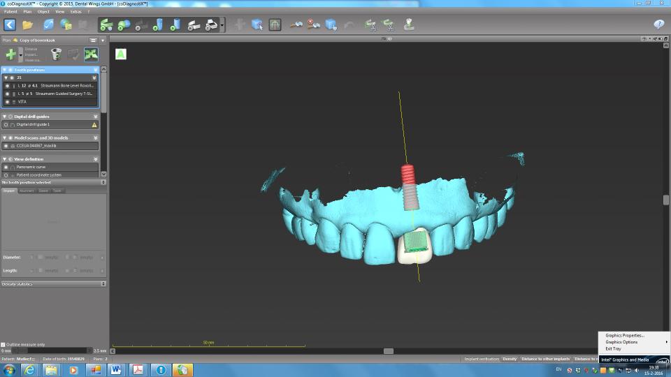 Fig. 12: Computer planning with the planned implant and tooth-supported surgical guide