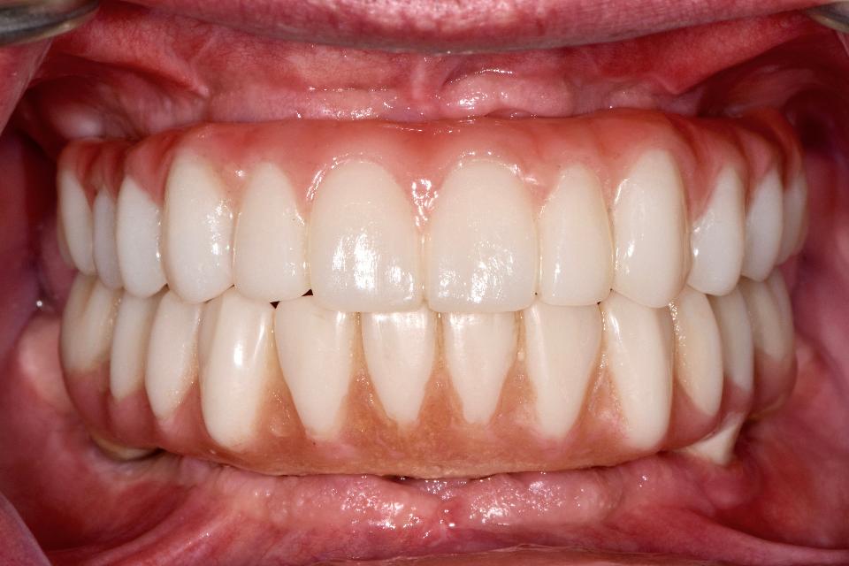 Fig. 9: The maxillary prosthesis was milled with a tooth-colored PMMA CAD/CAM block and layered with soft-tissue-colored laboratory composite resin