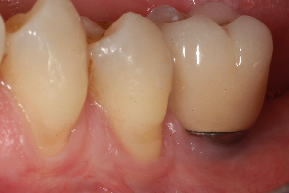 Fig. 4d: Clinical situation 6 months after delivery of the ceramic crown