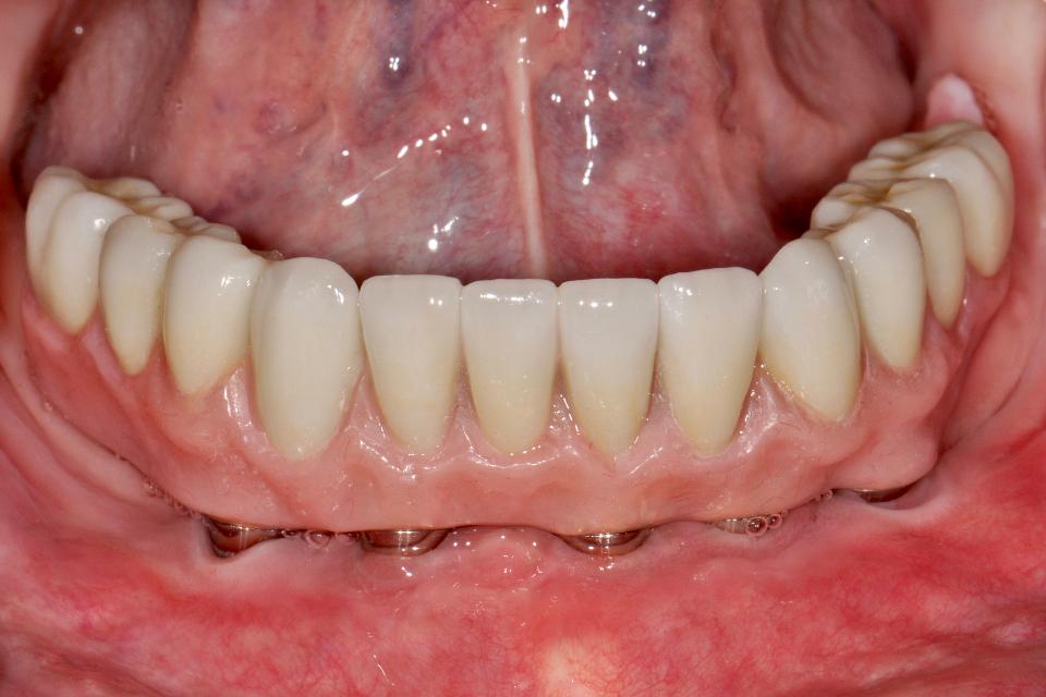 Fig. 53: Implant-supported complete fixed dental prosthesis (titanium framework and individual monolithic zirconia crowns)