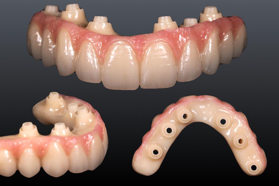 Fig. 28: Milled PMMA can be used as a prototype prothesis testing the functional and esthetic outcomes prior to the fabrication of definitive zirconia prosthesis