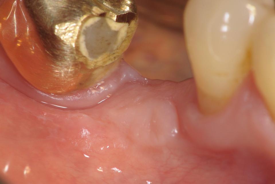 Fig. 3d: Clinical situation 3 months after mucogingival surgery