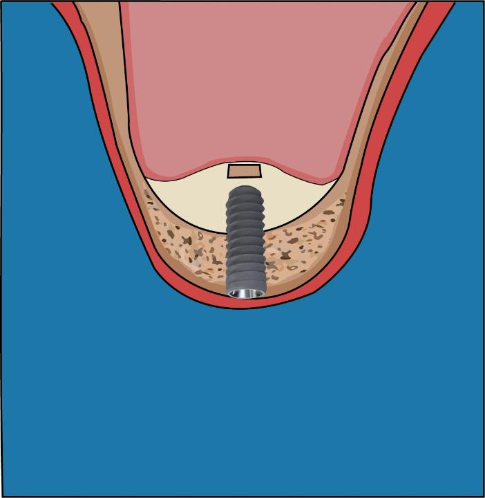 Fig. 5b: Implant stabilized in the residual bone with apex in the elevated sinus