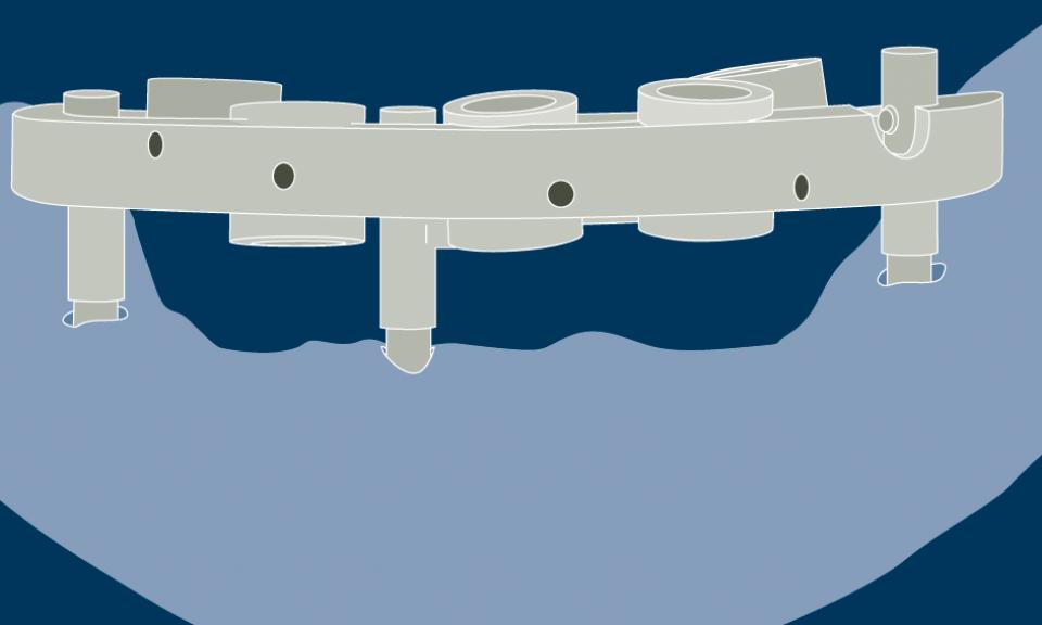 Fig. 5: Pin/implant-supported guides