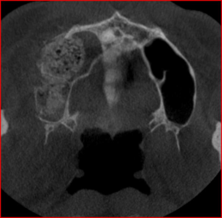 Fig. 6d: Post-operative CBCT showing bone grafting was performed anterior and posterior to the sinus septa