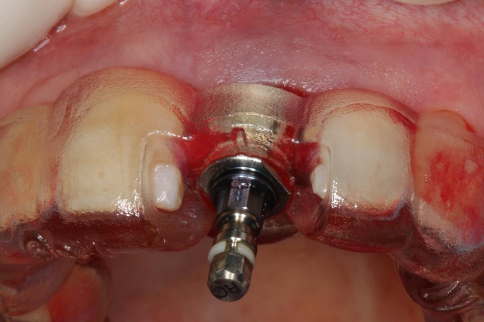 Fig. 17: Implant insertion through the surgical guide