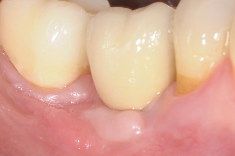 Fig. 3g: Clinical situation 2 years after delivery of definitive crown