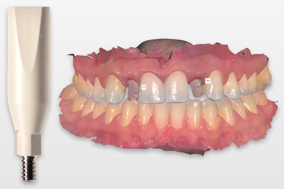 Fig. 2: When combined with a scan body, an intraoral scan can record the position and the timing of dental implants for the subsequent prosthesis fabrication