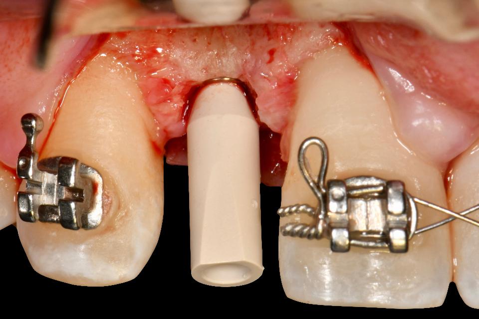 Fig. 3: An intraoral scan is more hygienic when an impression is desired during surgery. It may be of clinical convenience and ease if a patient is undergoing orthodontic treatment and is fitted with orthodontic brackets