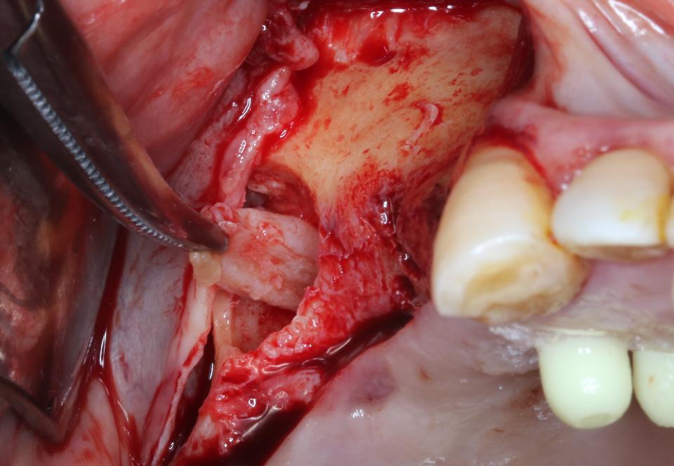 Fig. 7: A lateral window was created to remove the sinus cyst before MSFE