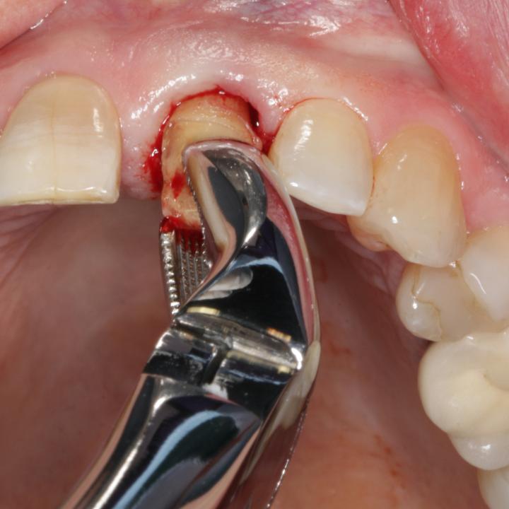 Fig. 13: Atraumatic tooth extraction