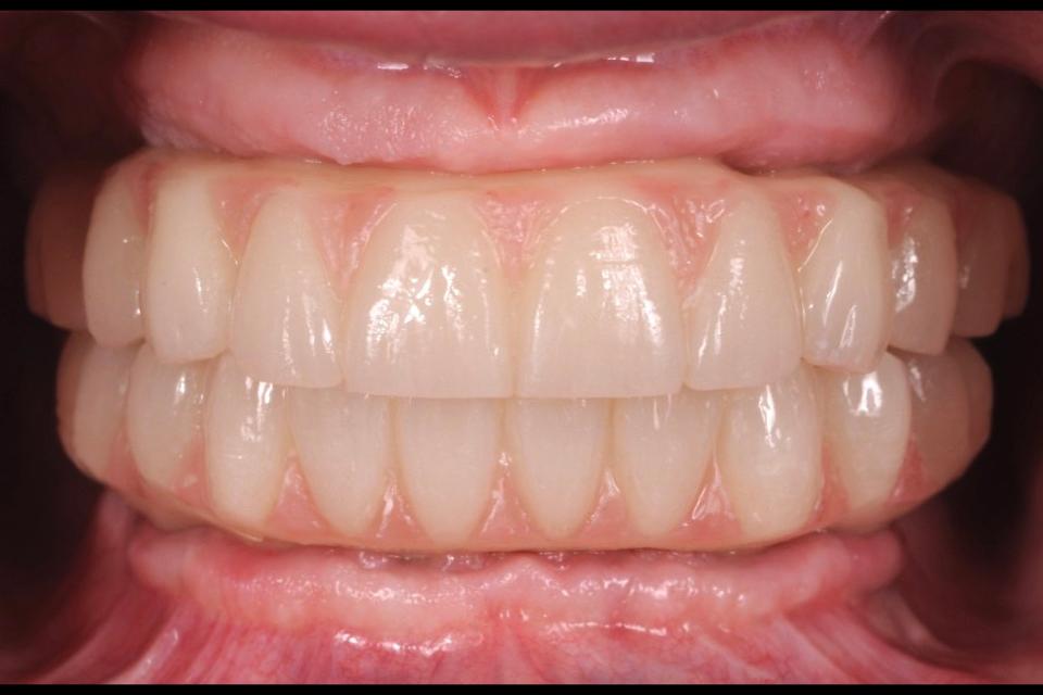 Fig. 29: After 1 to 2 months of intraoral function, the prototype prostheses may demonstrate occlusal changes resulting from patient’s dynamic occlusion. The prototype prostheses can be sent back to the dental technician to be used as a reference when designing the definitive prostheses