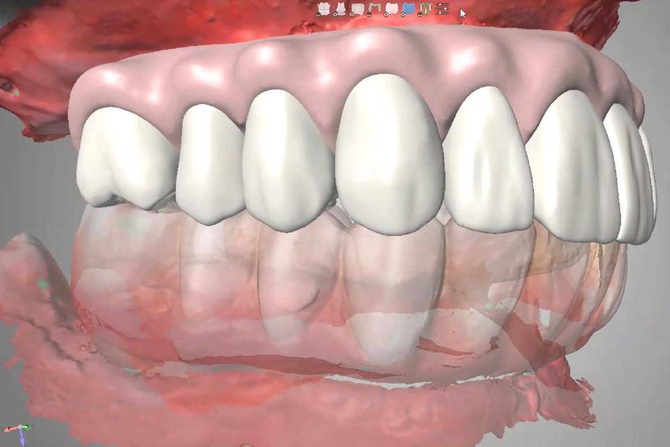 Fig. 7: The intraoral scan was sent to the dental laboratory for the design and fabrication of a CAD/CAM interim PMMA hybrid prosthesis