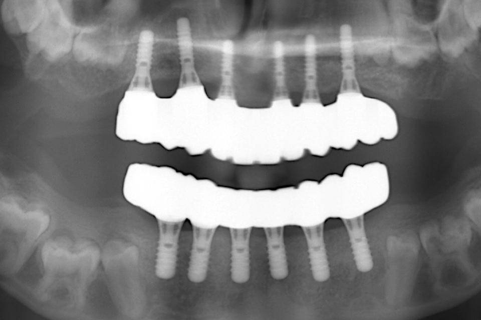 Fig. 34: Post-operative panoramic radiograph