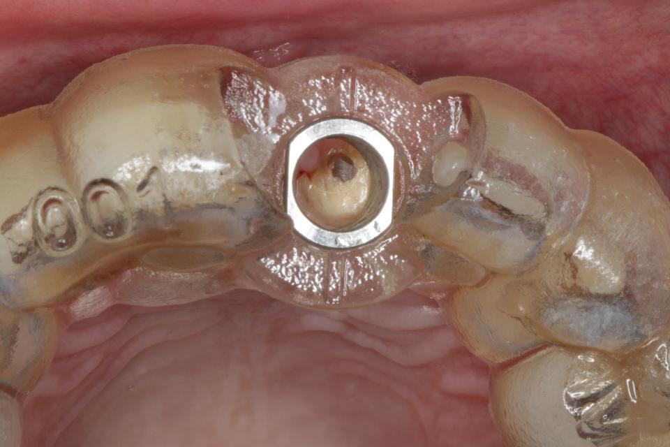 Fig. 15: Sleeved surgical guide in situ