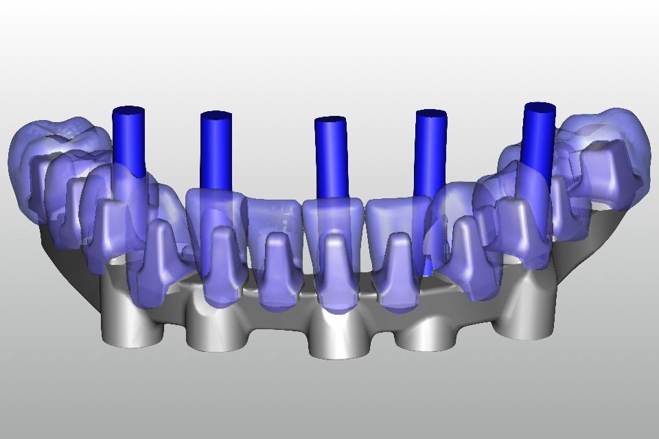 Fig. 51: Design of the CAD/CAM crowns fitting on the framework