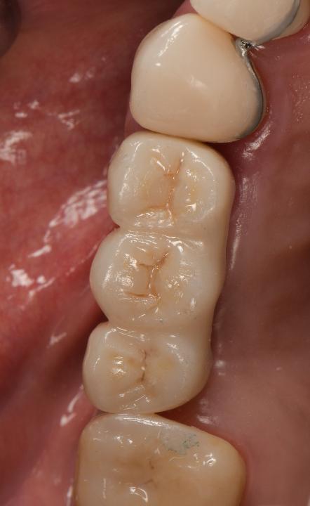 Fig. 7b: Clinical view of an implant-supported zirconia FDP with rounded buccal embrasures and filled palatal/lingual embrasures