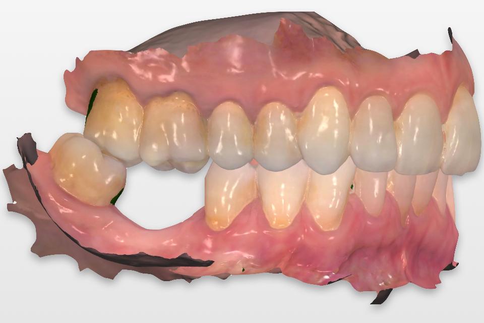 Fig. 1: An intraoral scan can be used for the pre-operative diagnosis and treatment planning of static computer-aided implant surgery (s-CAIS)