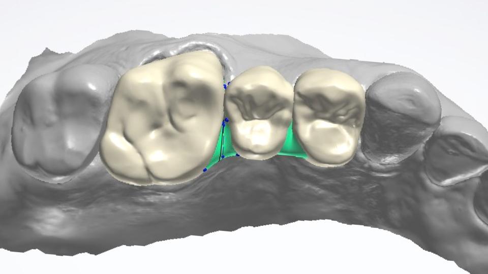 Fig. 7a: Increasing connector surface area by removing palatal/lingual embrasures