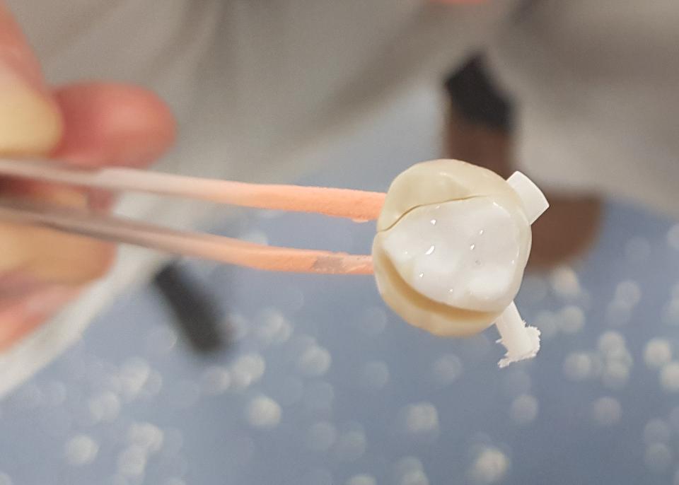 Fig. 6: Multiple fractures of the zirconia crown due to incorrect heating and annealing protocols