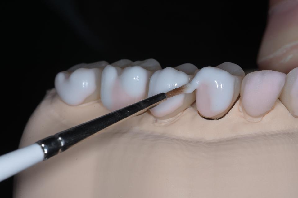 Fig. 4: Buccal micro-veneering of zirconia restorations