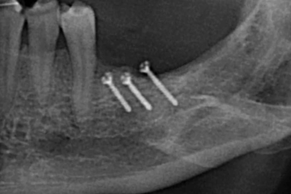 Fig. 4a: A 44-year old female, presenting bone atrophy in the posterior left mandible, was seeking implant placement in Fall 2007. Radiograph after bone blocks were fixed to the mandible