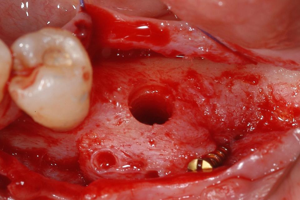 Fig. 4b: Bone anatomy upon surgical re-entry after 5 months, for the placement of a Wide Neck Implant (WNI)