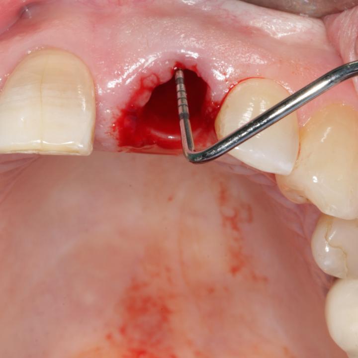 Fig. 14: Buccal bone examination