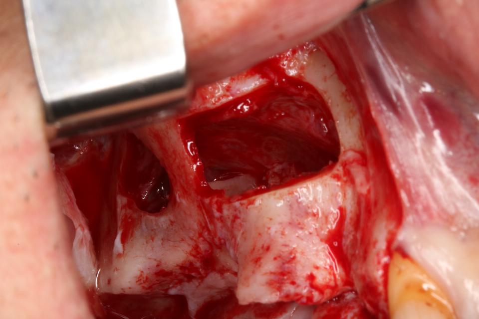 Fig. 6c: Two windows were created on each side of the septa, and the sinus membrane was elevated around the bony projection