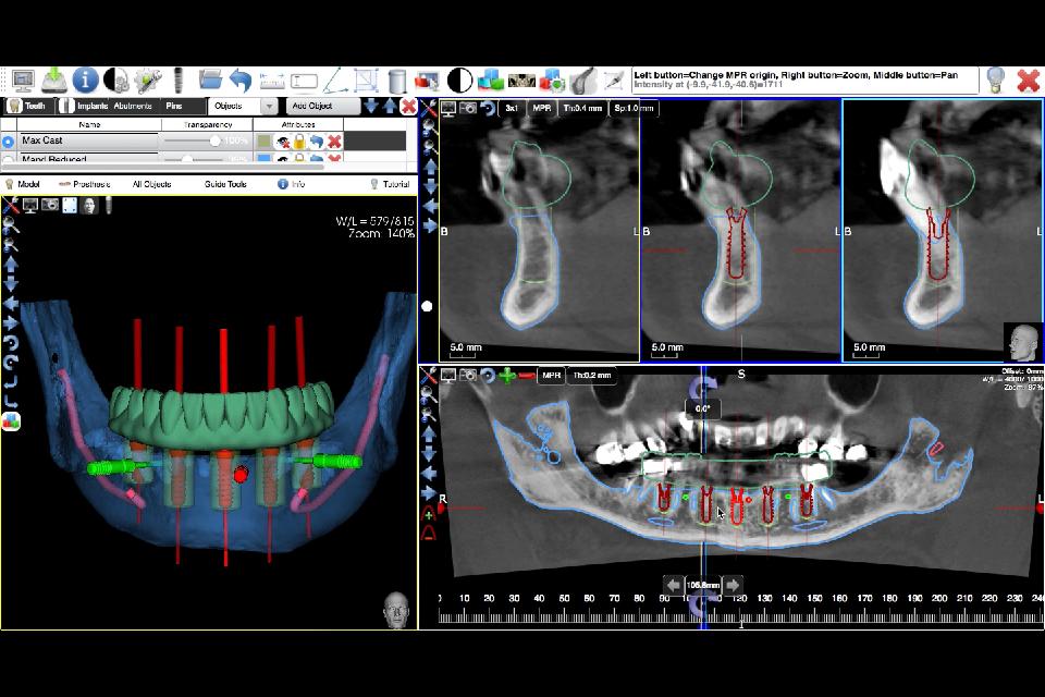 Fig. 21: The approved diagnostic tooth arrangement can be used for prosthetically-driven s-CAIS planning