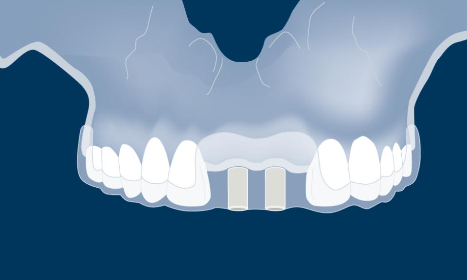 Fig. 2: Tooth-supported guide