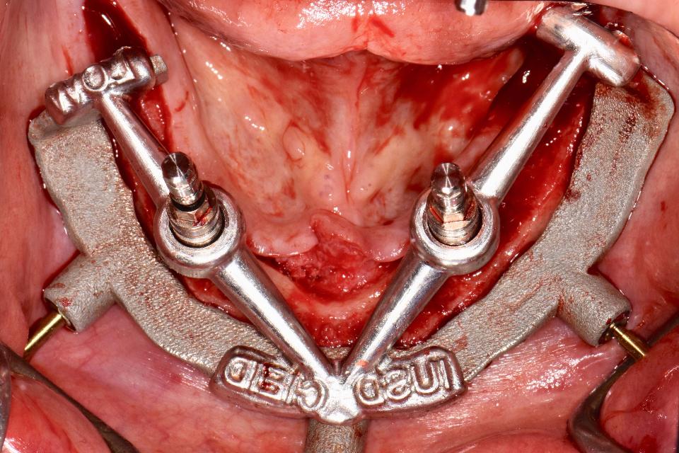 Fig. 40: The bone reduction and surgical template can be milled or printed from the cobalt-chromium (Co-Cr) or titanium alloy. Although the production cost with these materials could be higher, they offer superior mechanical strength and accuracy, which may in turn reduce the intra-operative complications, such as fracture of templates, insufficient mouth opening leading to insufficient operation access, and aggressive flap design needed to accommodate the bulky resin templates