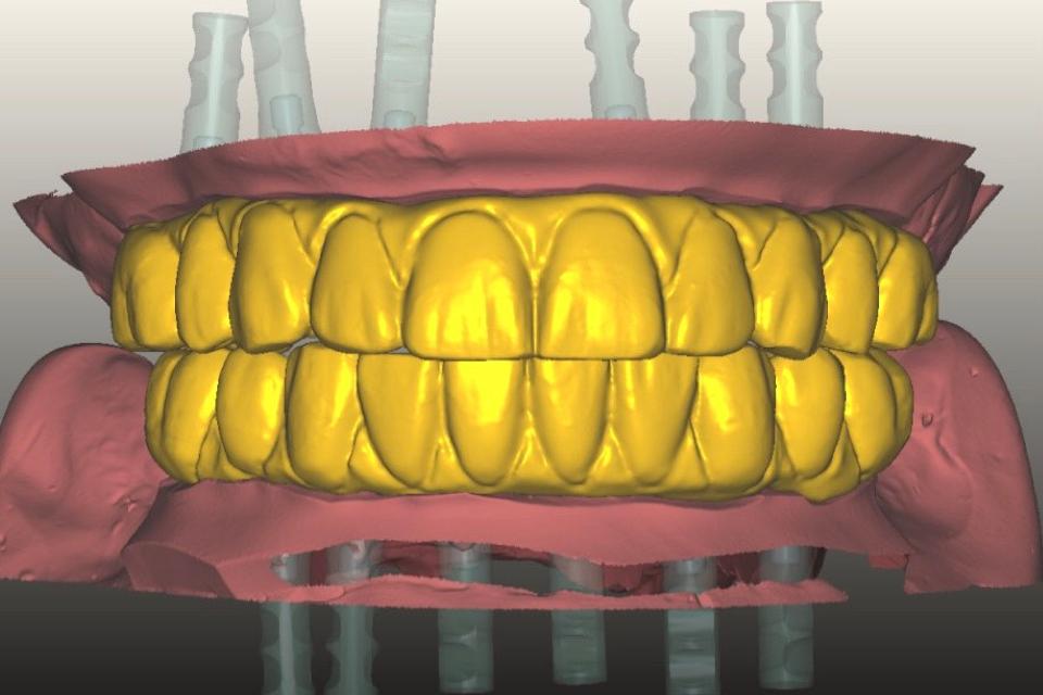 Fig. 30: Design of definitive zirconia prostheses