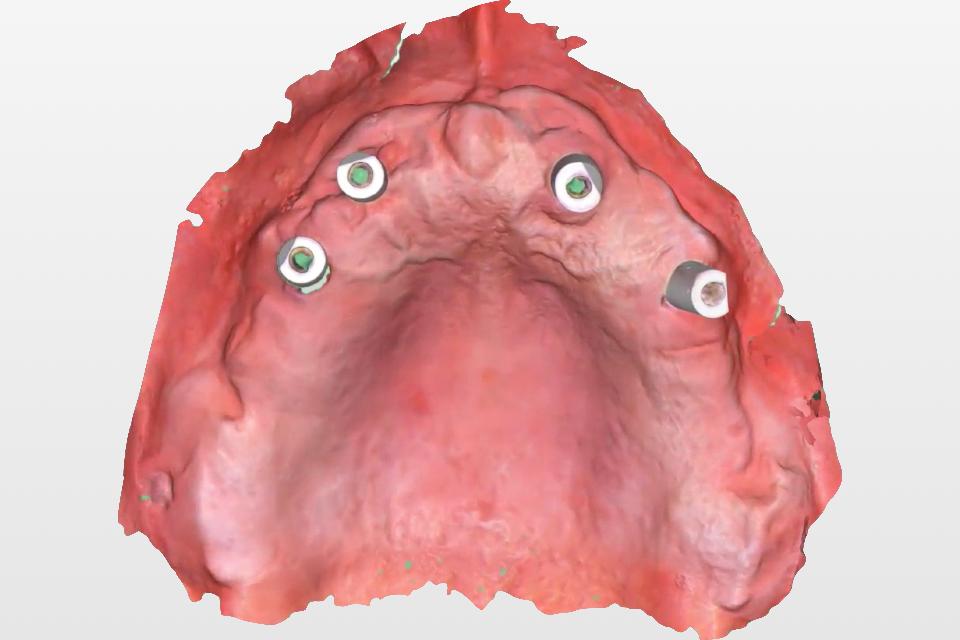 Fig. 6: Scanning the edentulous patient can pose a clinical challenge to capturing an accurate soft tissue extension, the maxillomandibular relationship, and inter-implant relationships