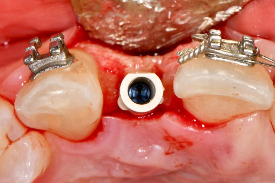 Fig. 4: The bevel near occlusal third on a scan body is a critical design for the CAD/CAM software to register the implant position and timing. The scan body should be positioned in a way that the bevel on the scan body facing area is easily accessible for intraoral scanning (generally speaking, towards the facial surface)